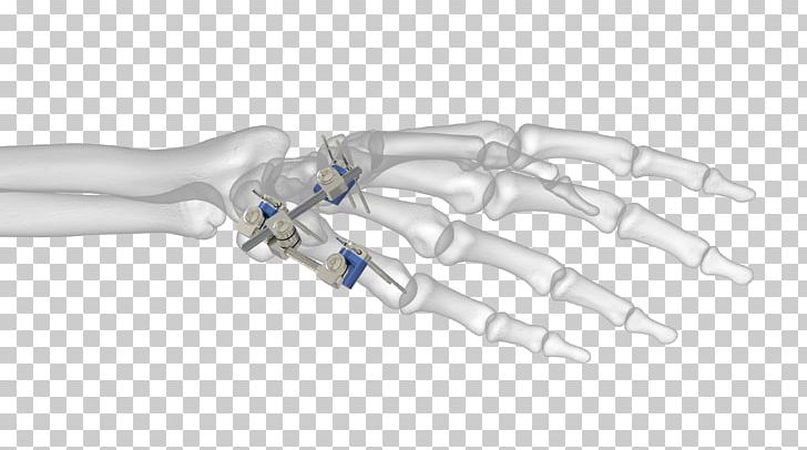 Thumb Ortho-aktiv Medizintechnik GmbH External Fixation Distal Radius Fracture Bone PNG, Clipart, Arm, Bone, Bone Fracture, Device, Distal Free PNG Download