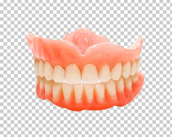 Dentures Removable Partial Denture Dental Implant Dentistry PNG, Clipart, Bridge, Chewing, Cosmetic Dentistry, Crown, Dentistry Free PNG Download