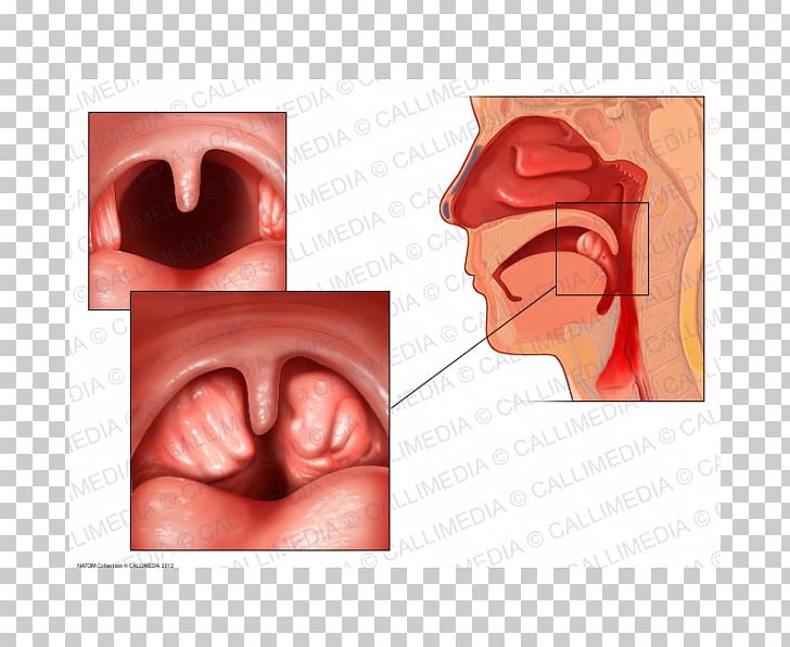 Tonsillitis Anatomy Adenoid Infection PNG, Clipart, Adenoid, Adenoid Hypertrophy, Anatomy, Cheek, Chin Free PNG Download