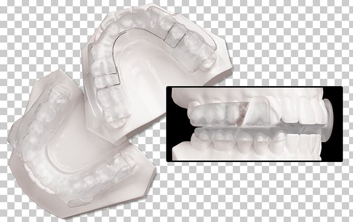 Splint Temporomandibular Joint Dysfunction Dentistry Jaw Orthopedic Surgery PNG, Clipart, Dentistry, Dorsal Fin, Home Appliance, Incisor, Jaw Free PNG Download