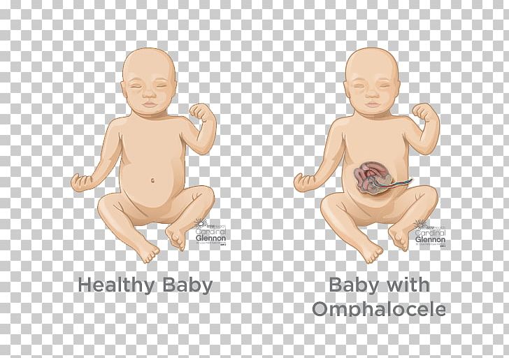 Pulmonary Hypoplasia Congenital Pulmonary Airway Malformation Birth Defect Lung Pulmonary Artery PNG, Clipart, Arm, Birth Defect, Child, Congenital Diaphragmatic Hernia, Diagnosis And Treatment Free PNG Download