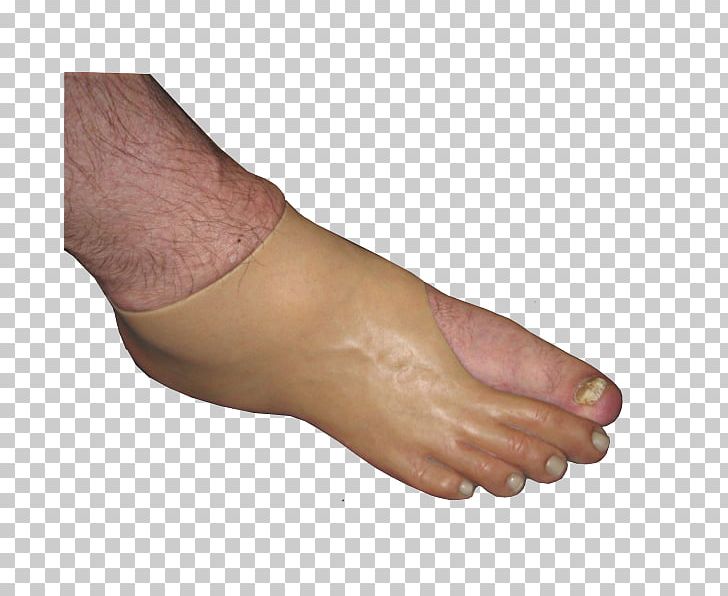 Thumb Toe Foot Amputation Prosthesis PNG, Clipart, Amputation, Ankle, Arm, Digit, Disarticulation Free PNG Download