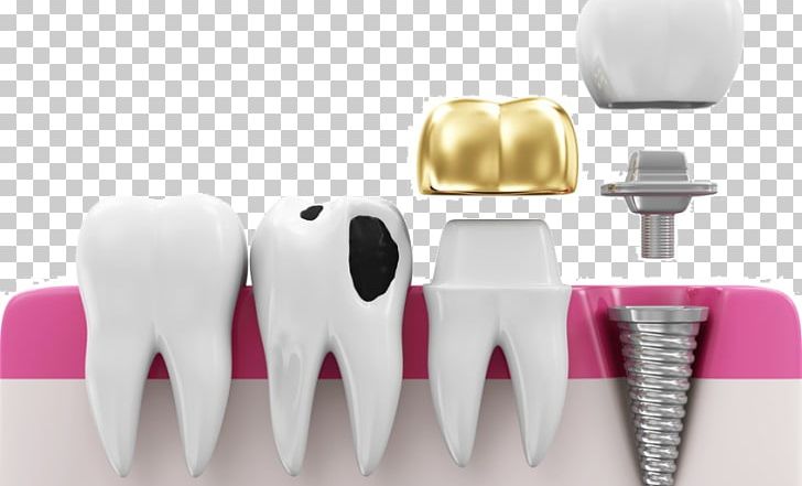 Crown Dentistry Dental Implant Bridge PNG, Clipart, Bridge, Caries, Crown, Dental, Dental Implant Free PNG Download