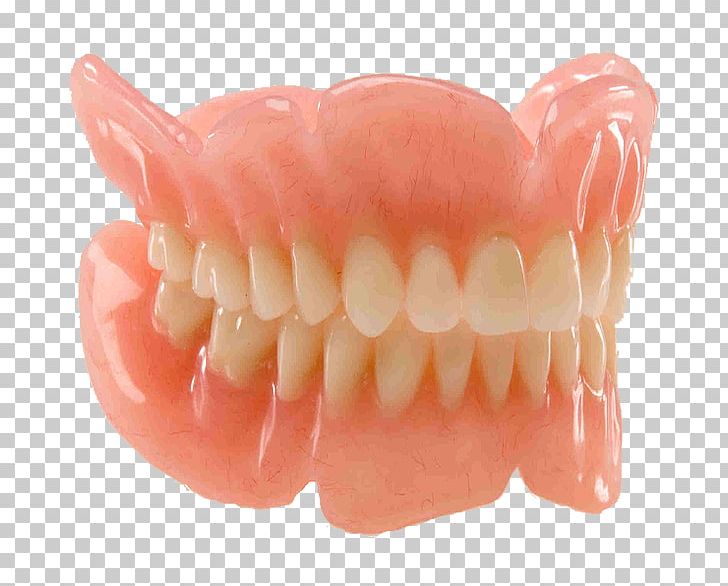 Dentures Dentistry Removable Partial Denture Prosthesis Dental Implant PNG, Clipart, Bridge, Clinic, Dental, Dental Implant, Dental Laboratory Free PNG Download
