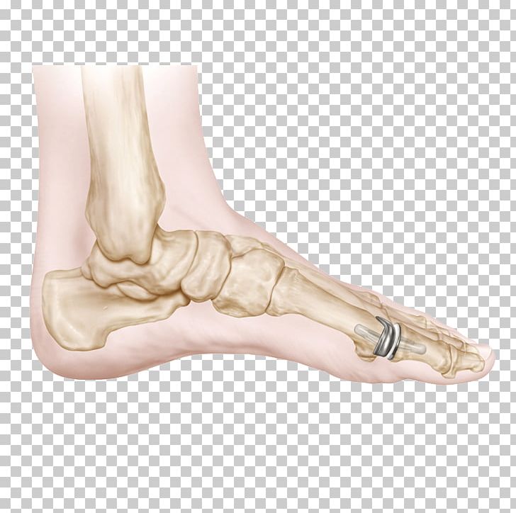 Implant Thumb Medicine Biomedical Engineering Orthopaedics PNG, Clipart, Ankle, Arm, Artificial Cardiac Pacemaker, Biomedical Engineering, Composite Material Free PNG Download