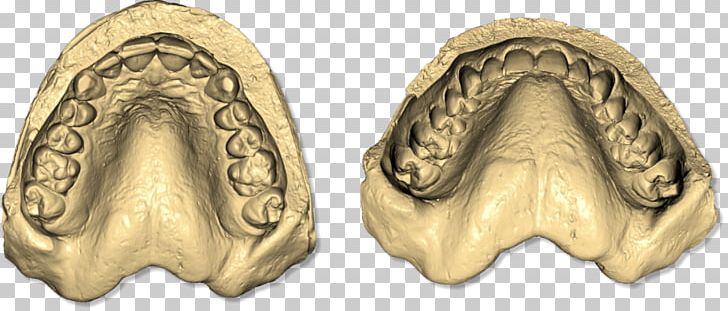 Dental Impression Dentistry Scanner Dental Implant Tooth PNG, Clipart, 3d Scanner, Abutment, Body Jewelry, Computer Software, Dental Free PNG Download