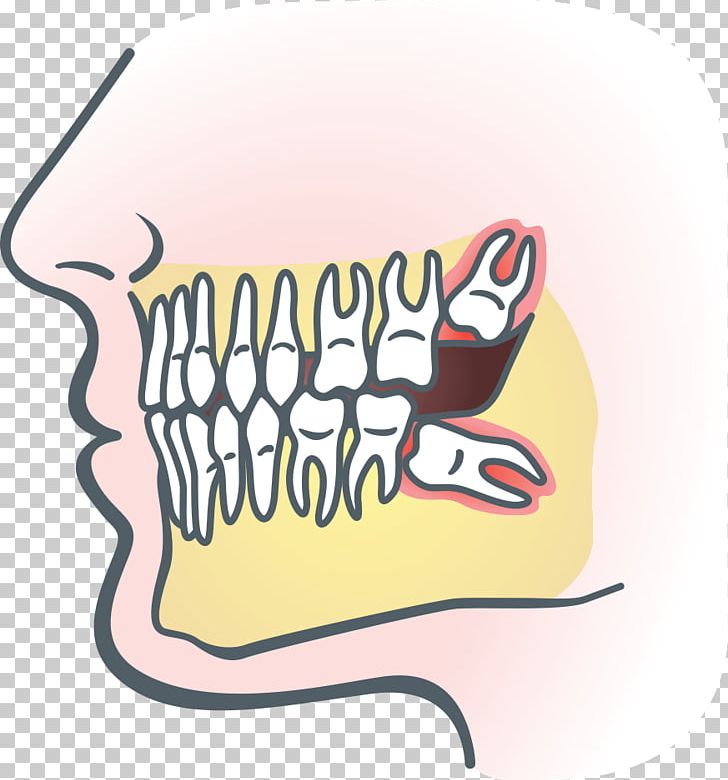 Wisdom Tooth Dental Extraction Impacted Wisdom Teeth Dentistry Tooth Impaction PNG, Clipart, Area, Art, Brand, Cartoon, Dental Surgery Free PNG Download