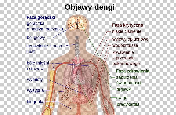 Dengue Fever Disease Virus Yellow Fever Mosquito Symptom PNG, Clipart, Abdomen, Angle, Arm, Blood Vessel, Chikungunya Virus Infection Free PNG Download