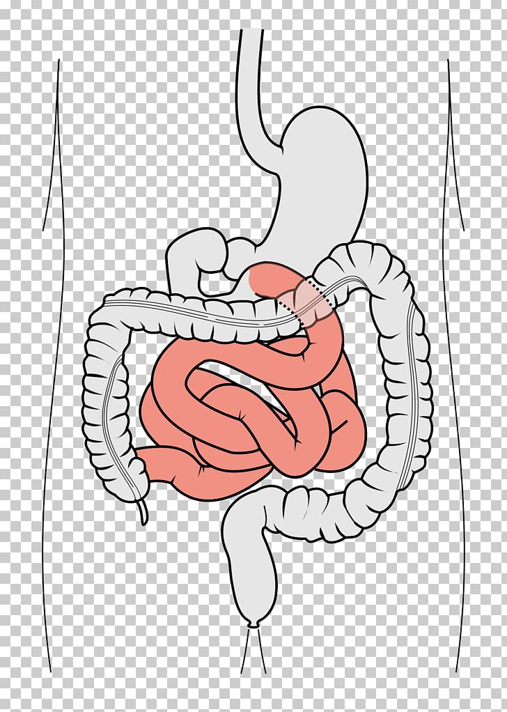 Gastrointestinal Tract Large Intestine Small Intestine Duodenum Leaky Gut Syndrome PNG, Clipart, Abdomen, Area, Arm, Art, Bloating Free PNG Download