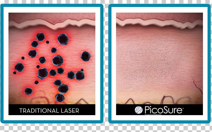 Tattoo Removal L'Arte Della Bellezza Laser Tattoo Artist PNG, Clipart,  Free PNG Download