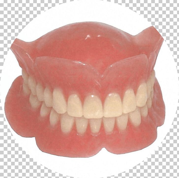 Dentures Dentistry Removable Partial Denture Dental Implant PNG, Clipart, Allon4, Bridge, Cosmetic Dentistry, Dental Implant, Dental Laboratory Free PNG Download