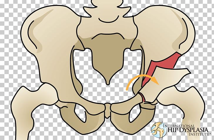Osteotomy Hip Dysplasia Acetabulum Femur PNG, Clipart, Acetabulum, Arm, Bone, Bone Fracture, Bones Free PNG Download