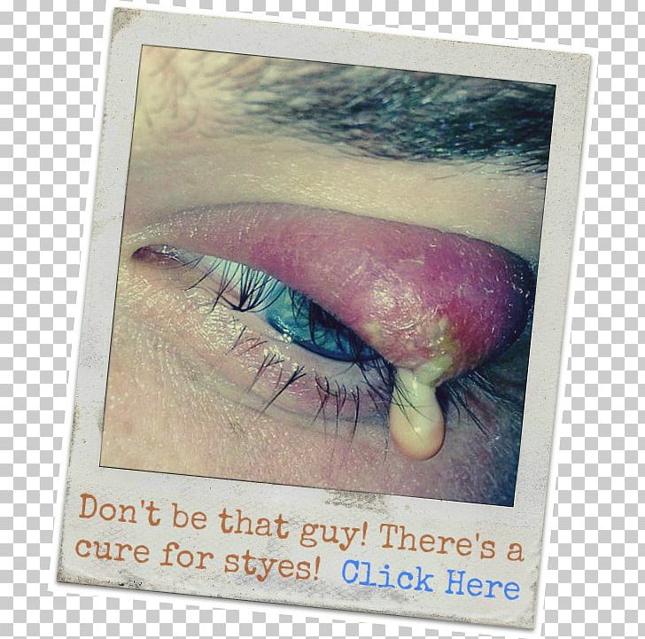 Stye Pharmaceutical Drug Warm Compress Eye Drops & Lubricants PNG, Clipart, Amp, Antibiotics, Ciprofloxacin, Cure, Dry Eye Syndrome Free PNG Download
