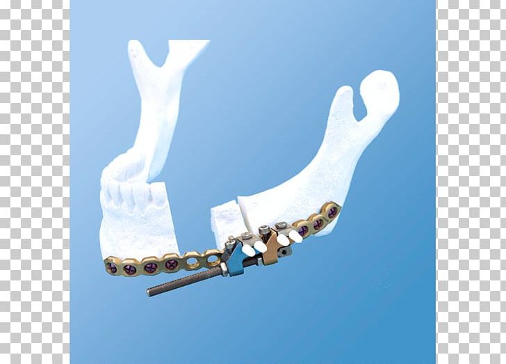 Mandible Distraction Osteogenesis Bone DePuy Synthes Companies PNG, Clipart, Angle, Bone, Condyloid Process, Depuy Synthes Companies, Distraction Osteogenesis Free PNG Download