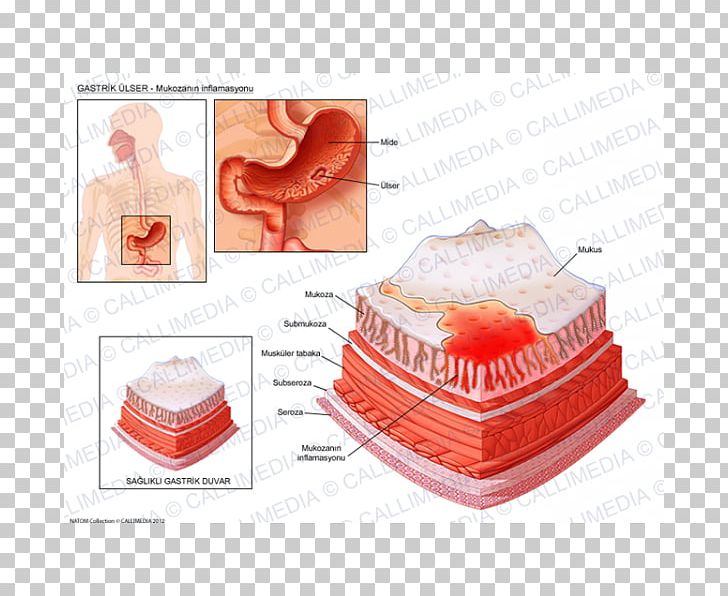 Peptic Ulcer Disease Skin Ulcer Erosion Inflammation Gastritis PNG, Clipart, Disease, Erosion, Gastritis, Gastroenterology, Gastrointestinal Disease Free PNG Download