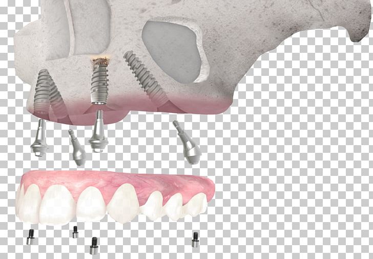 Tooth Dental Implant Dentistry All-on-4 PNG, Clipart, All , Allon4, Bone, Cosmetic Dentistry, Dental Implant Free PNG Download