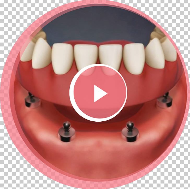Tooth Dental Implant Dentures Removable Partial Denture PNG, Clipart, Cheek, Dental Degree, Dental Implant, Dental Restoration, Dentistry Free PNG Download