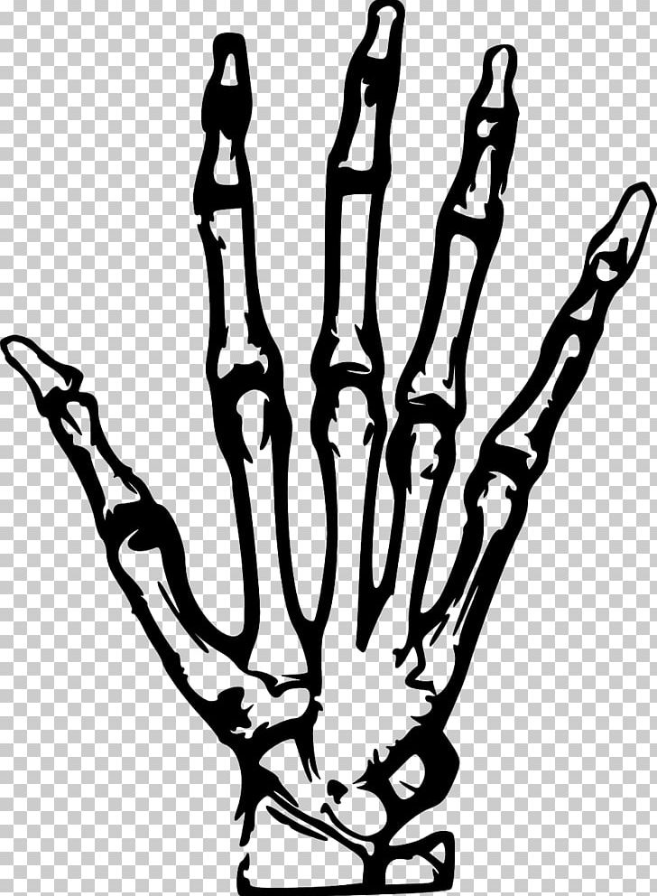 X-ray Hand PNG, Clipart, Arm, Black And White, Branch, Chest Radiograph, Finger Free PNG Download