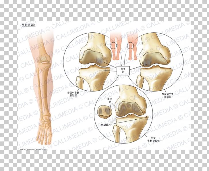 Knee Arthritis Osteoarthritis Pain PNG, Clipart, Abdomen, Arm, Arthritis, Bone, Ear Free PNG Download