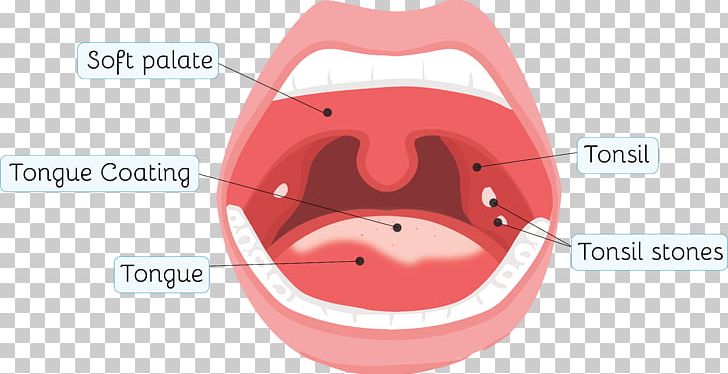 Tonsillolith Tonsillitis Throat Health PNG, Clipart, Area, Hardware, Health, Others, Smile Free PNG Download