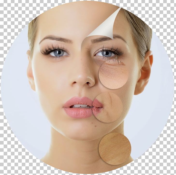 Chemical Peel Skin Wrinkle Facial Exfoliation PNG, Clipart, Blepharoplasty, Botulinum Toxin, Che, Cheek, Chin Free PNG Download