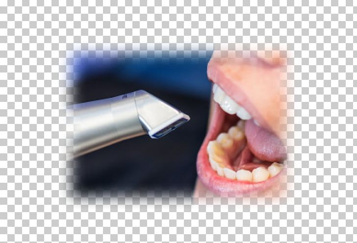 Tooth Scanner CAD/CAM Dentistry Escáner PNG, Clipart, Cadcam Dentistry, Closeup, Crown, Dentist, Dentistry Free PNG Download