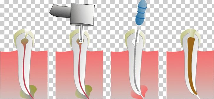 Root Canal Endodontic Therapy Dentistry Medical Procedure PNG, Clipart, Brush, Canal, Cosmetic Dentistry, Dental Restoration, Dental Surgery Free PNG Download