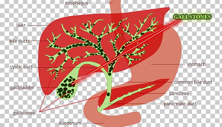 The Liver And Gallbladder Miracle Cleanse Gallbladder Flush Gallstone PNG, Clipart,  Free PNG Download
