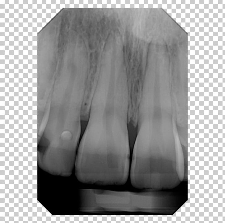 Digital Radiography X-ray Dental Radiography Cone Beam Computed Tomography PNG, Clipart, Angle, Black And White, Dentist, Dentistry, Digital Dentistry Free PNG Download