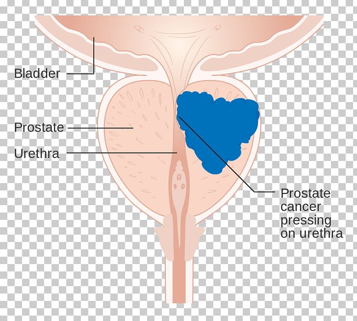 Prostate Cancer Gland Urology PNG, Clipart, Bladder Cancer, Cancer, Diagram, Disease, Gland Free PNG Download