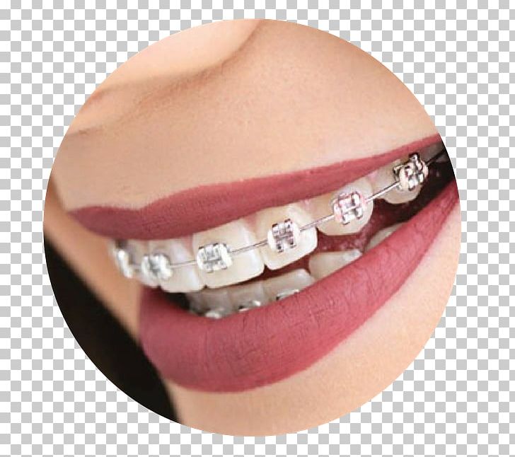 Dental Braces Tooth Dentistry Video PNG, Clipart, Aesthetics, Chin, Dental Braces, Dental Consonant, Dental Floss Free PNG Download