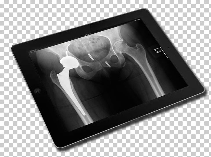 Joint Replacement Anesthesia Surgery General Anaesthesia PNG, Clipart, Anesthesia, Anesthetic, Arm, Black And White, Complication Free PNG Download