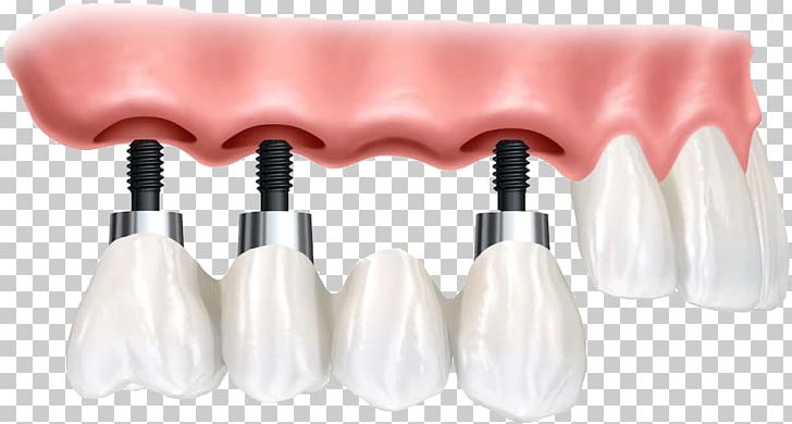 Dental Implant Dentistry Dentures Tooth Loss PNG, Clipart, Bridge, Brush, Cosmetics, Crown, Dental Free PNG Download
