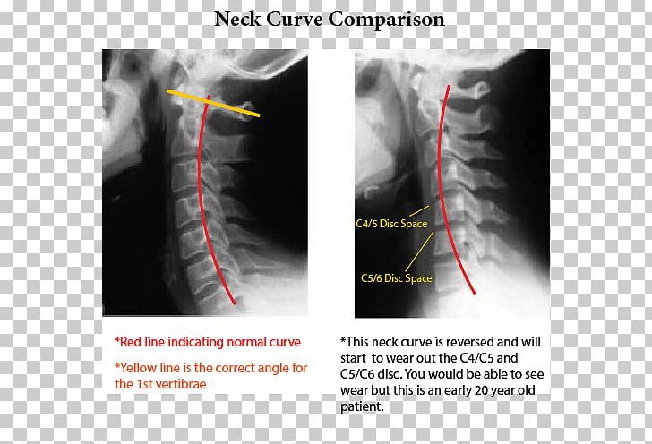 Neck Pain Whiplash Cervical Vertebrae X-ray PNG, Clipart, Angle, Cervical Vertebrae, Chiropractic, Headache, Health Care Free PNG Download