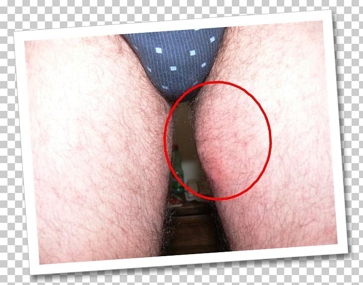 Ingrown Hair Comedo Pimple Thigh Png Clipart Abscess Acne