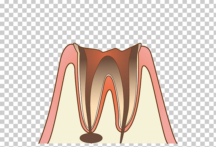 歯科 Dentist Therapy Tooth Decay 診療 PNG, Clipart, Angle, Bridge, Cavity, Dentist, Dentures Free PNG Download