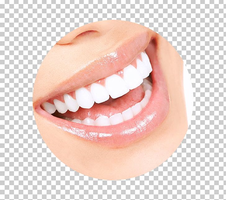 Tooth Whitening Human Tooth Dentistry Veneer PNG, Clipart, Cheek, Chin, Color, Cosmetic Dentistry, Dental Calculus Free PNG Download