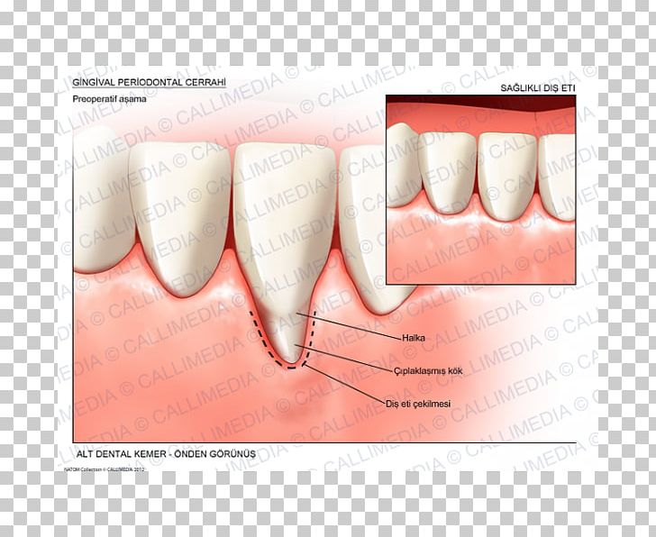 Tooth Gums Gingival Recession Surgery Periodontal Disease PNG, Clipart, 3 Months, Cerrahi, Dental Implant, Dentist, Dentistry Free PNG Download