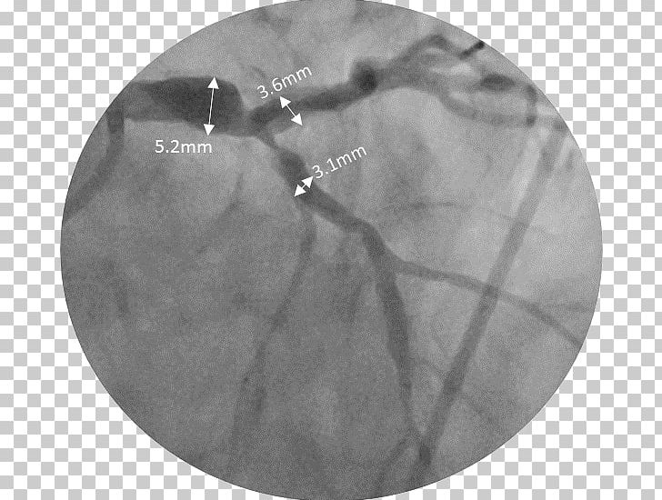 Stenting Medicine Coronary Stent Cardiology Complication PNG, Clipart, Adaptation, Black And White, Cardiology, Circle, Complication Free PNG Download