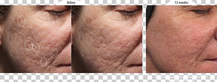 Scar Injectable Filler Acne Wrinkle Artefill PNG, Clipart, Acne, Artefill, Cheek, Chin, Closeup Free PNG Download