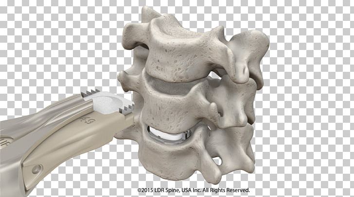 Intervertebral Disc Arthroplasty Anterior Cervical Discectomy And Fusion Spinal Fusion Implant PNG, Clipart, Artificial, Auto Part, Bone, Cervical, Cervical Vertebrae Free PNG Download
