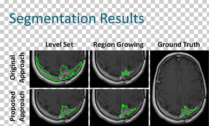 Segmentation Brain Tumor Magnetic Resonance Imaging Analysis Region Growing PNG, Clipart, Automotive Tire, Brand, Computer Vision, Digital Image Processing, Image Analysis Free PNG Download