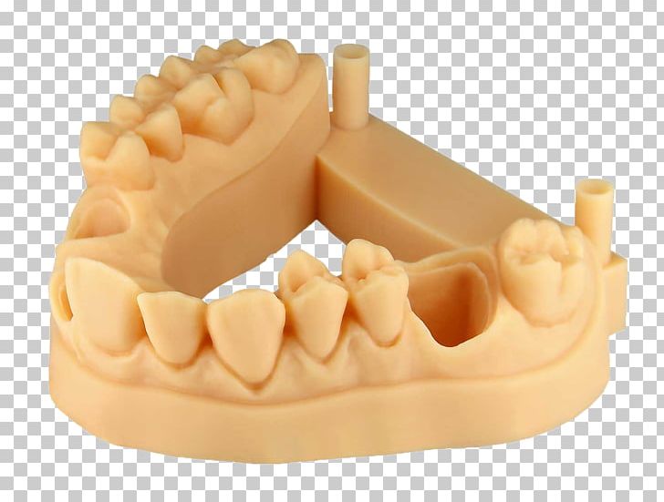 Tooth 3D Printing EnvisionTEC Crown Fabrication Additive PNG, Clipart, 3d Printing, Bridge, Crown, Dental, Dental Implant Free PNG Download