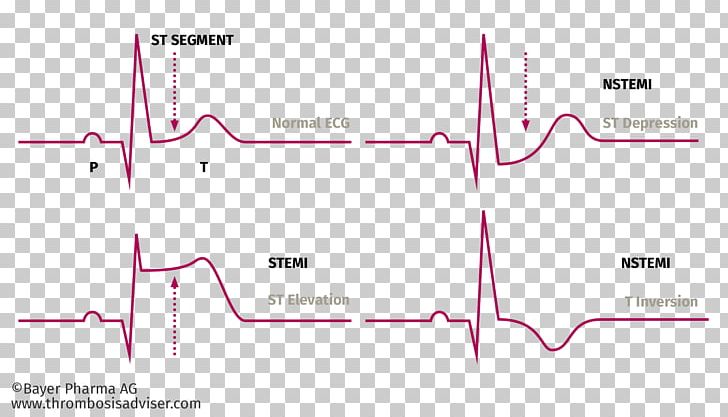 Acute Coronary Syndrome ST Segment Elevation Myocardial Infarction Angina Pectoris ST Elevation PNG, Clipart, Angle, Area, Cardiac Arrest, Chest Pain, Diagram Free PNG Download