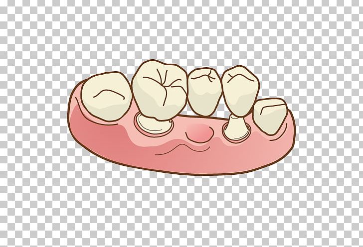 Dentist Dentures Therapy Dental Surgery 矯正歯科 PNG, Clipart, Bridge, Dental Implant, Dental Surgery, Dentist, Dentures Free PNG Download