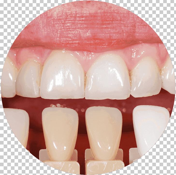 Tooth Whitening Cosmetic Dentistry Veneer PNG, Clipart, Bridge, Cosmetic Dentistry, Crown, Dental Implant, Dental Restoration Free PNG Download
