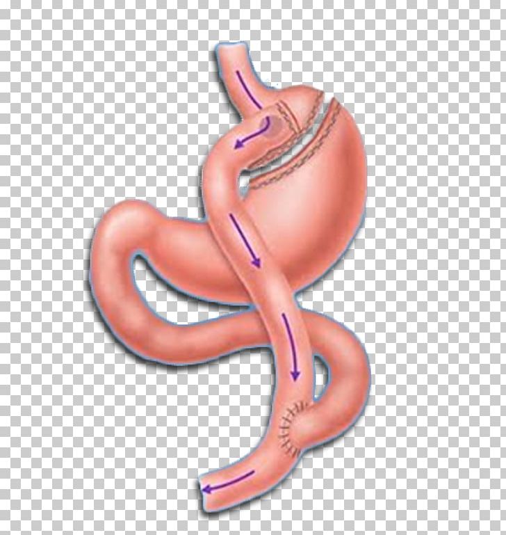 Roux-en-Y Anastomosis Gastric Bypass Surgery Bariatric Surgery Sleeve Gastrectomy PNG, Clipart, Bariatrics, Bariatric Surgery, Bypass, Bypass Surgery, Diabetes Mellitus Free PNG Download
