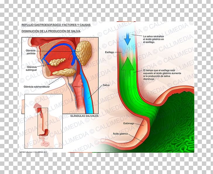 Gastroesophageal Reflux Disease Esophagus Saliva Gastro PNG, Clipart, Anatomy, Cough, Ear, Esophageal Cancer, Esophagus Free PNG Download