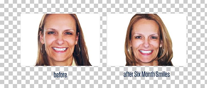 Cosmetic Dentistry Dental Braces Overbite PNG, Clipart, Blond, Brown Hair, Canine Tooth, Cheek, Chin Free PNG Download
