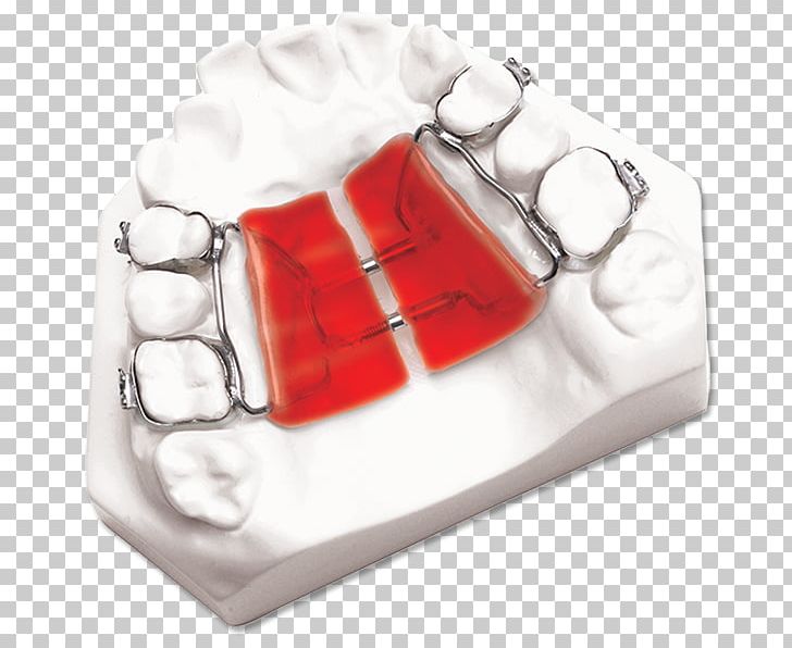 DynaFlex Palatal Expansion Orthodontics Orthodontic Technology Maxilla PNG, Clipart, Dynaflex, Home Appliance, Mandible, Maxilla, Orthodontics Free PNG Download